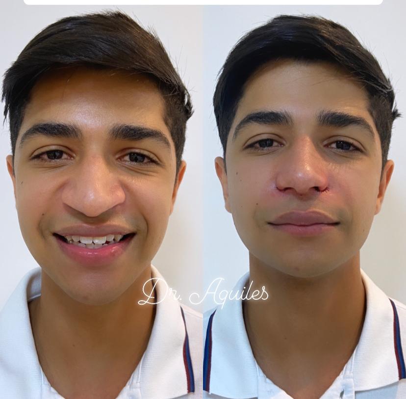 IMG 20200620 WA0118 Conheça Dr. Aquiles, Cirurgião Dentista referência em Harmonização Facial e Alectomia